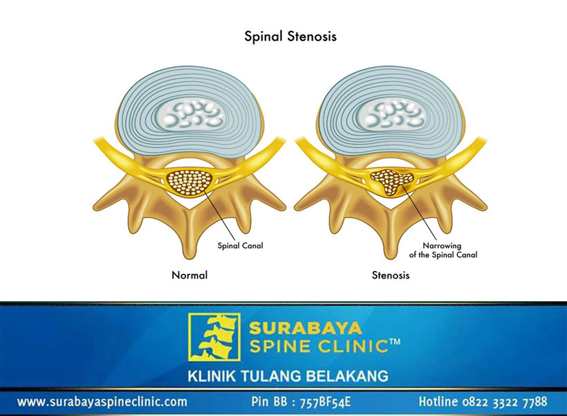 Spinal Stenosis, Kompresi Saraf Tulang Belakang